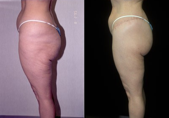 Thigh Lift