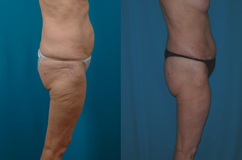 Thigh Lift