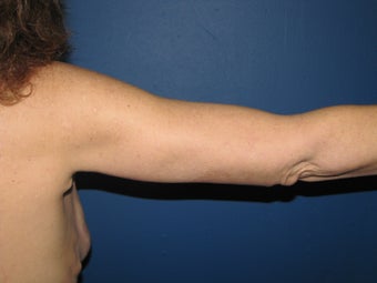 Brachioplasty