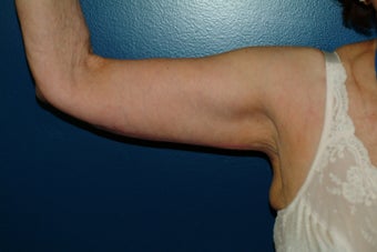 Brachioplasty