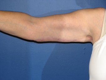Brachioplasty