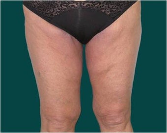 Thigh lift