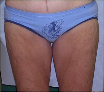 Thigh lift