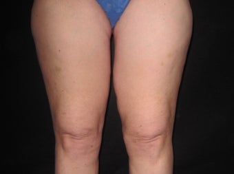 Thigh Lift