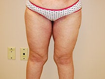 Thigh Lift 
