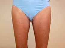 Thigh Lift