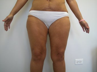 Thigh Lift 
