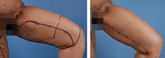 Thighplasty