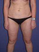 Thigh Lift