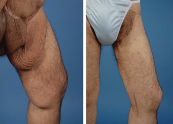 Thighplasty