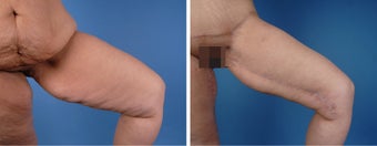 Thighplasty