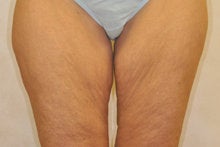 Medial (Inner) Thigh Lift