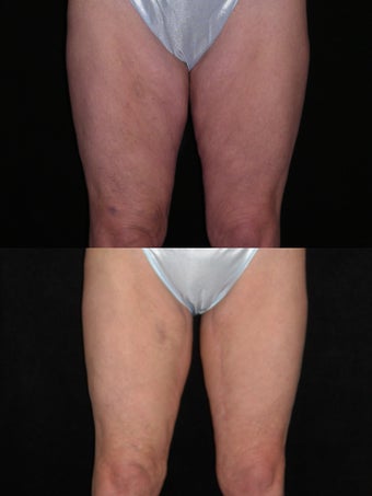 Medial thigh lift