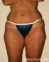 Thigh and Buttock Lift