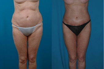 Thigh Lift