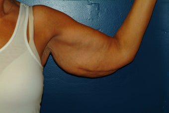 Brachioplasty
