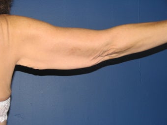 Brachioplasty