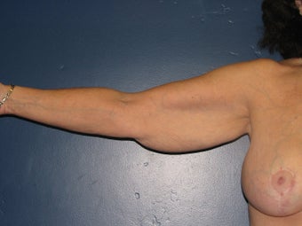 Brachioplasty