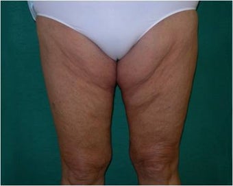 Thigh lift