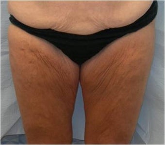 Thigh lift