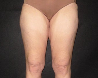 Thigh Lift