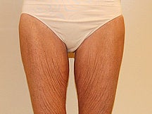 Thigh Lift