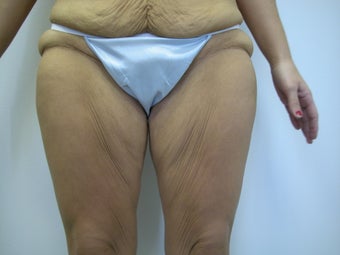 Thigh Lift 