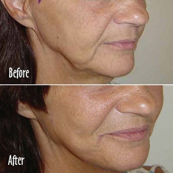 Threadlift of jowls and chin