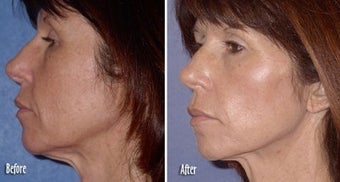 Threadlift for neck and jaw definition