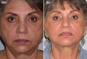 Threadlift to full face