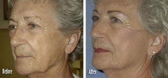 Threadlift to full face for jaw and neck definition