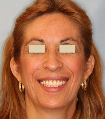 Dentures