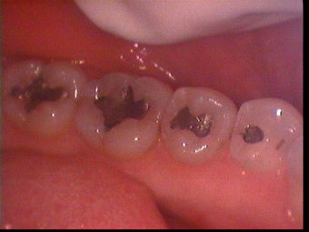 Tooth colored fillings