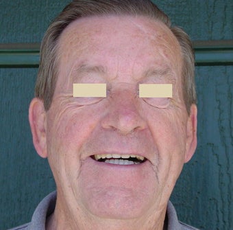 Dentures