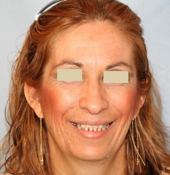 Dentures