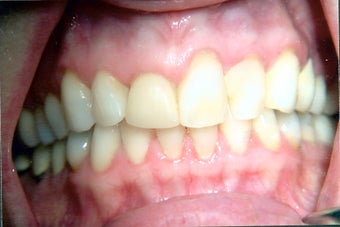 Combination of crowns, veneers, and gum surgery
