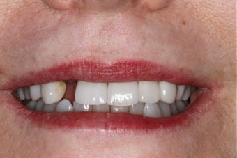 Cosmetic Dentistry - Fixed Bridge