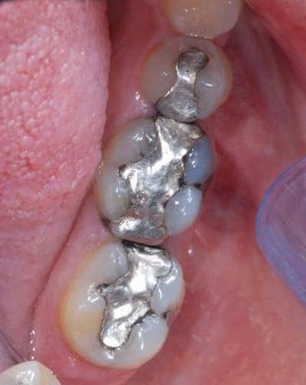 Mercury fillings replaced by white tooth colored fillings