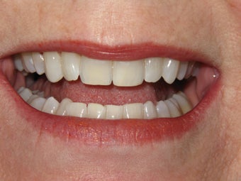 Reshaping of lower front teeth