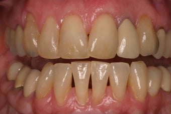 alloderm tissue graft