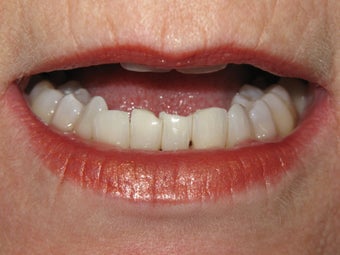Reshaping of lower front teeth