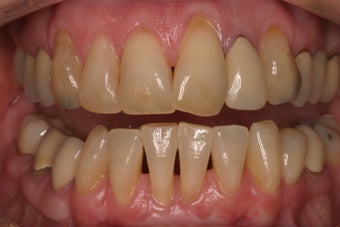 alloderm tissue graft