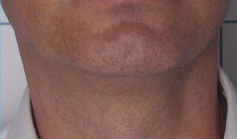 TriPollar