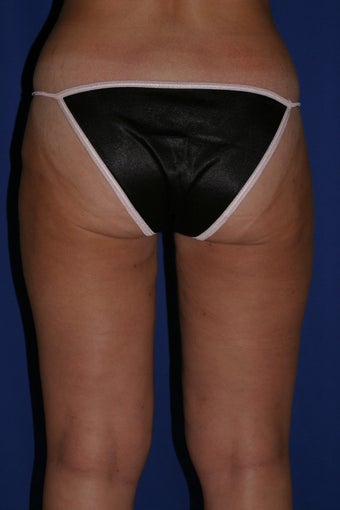 Liposuction