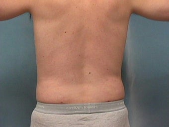 Liposuction
