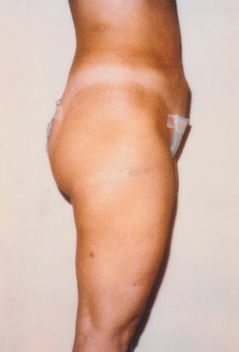 Liposuction