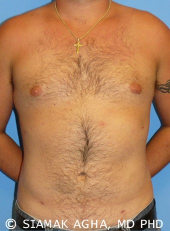 Tumescent liposuction