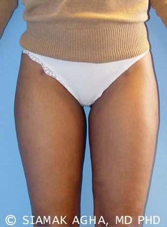 Liposuction