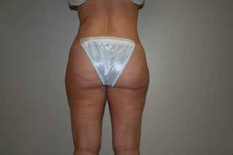 Liposuction of flanks and thighs