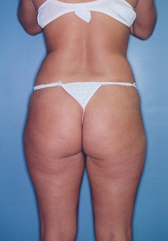Power Assisted Liposuction (Hips, Thighs, Stomach & Back)